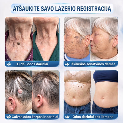 🪶🌟Oficiali parduotuvė | ✅️👩‍⚕️ 𝐇𝐈𝐒𝐊𝐈𝐍® 7 dienų odos išaugų ir dėmių šalinimo priemonė (𝐫𝐨𝐥𝐥-𝐨𝐧 𝐚𝐩𝐥𝐢𝐤𝐚𝐭𝐨𝐫𝐢𝐮𝐬: 𝐛𝐞 𝐬𝐤𝐚𝐮𝐬𝐦𝐨 𝐢𝐫 𝐫𝐚𝐧𝐝ų) 🌳